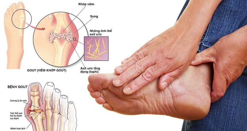 Những Điều Ngạc Nhiên Mà Bạn Chưa Biết Về Gout Và Cách Trị Bệnh